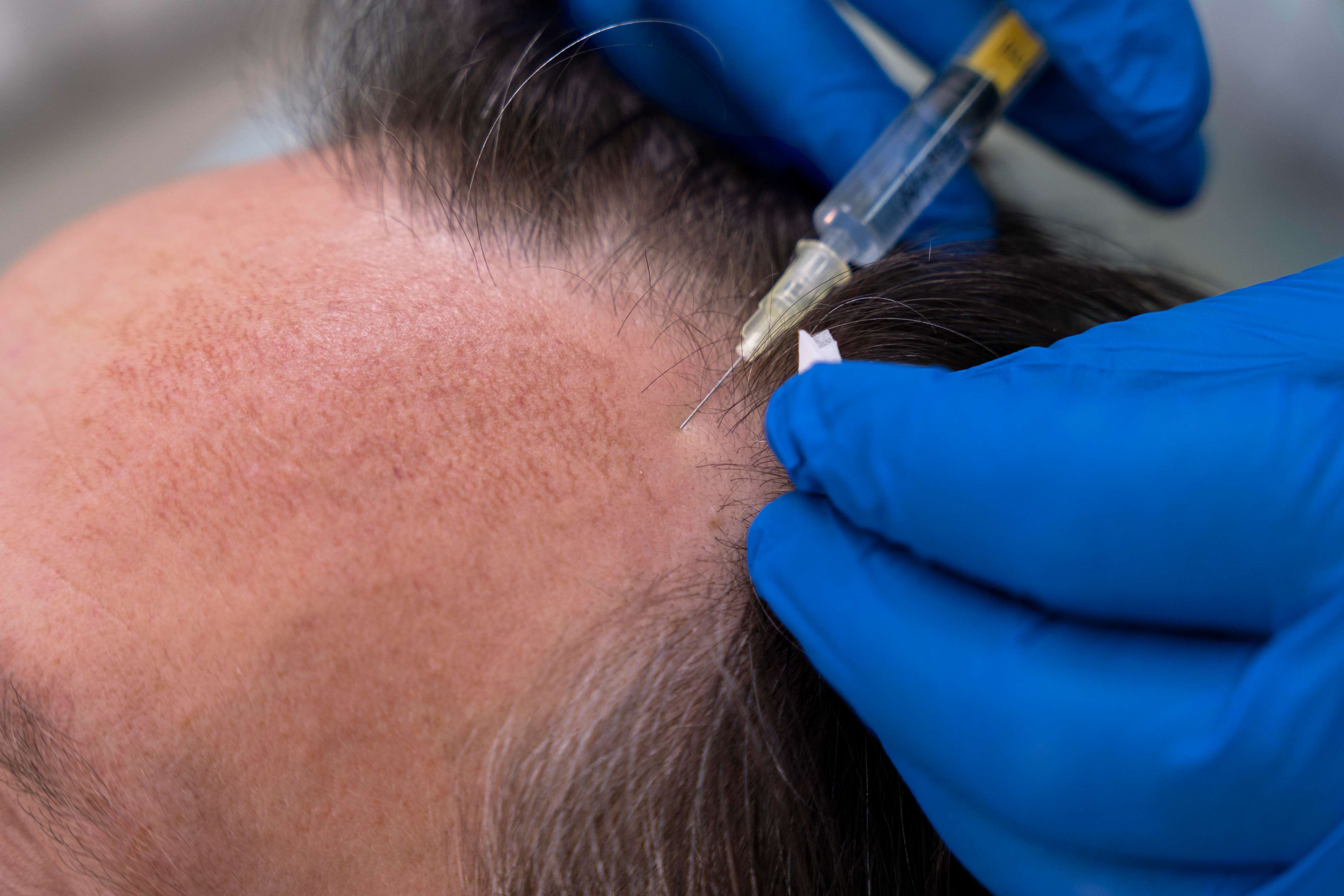 Polynucleotide hair treatment results